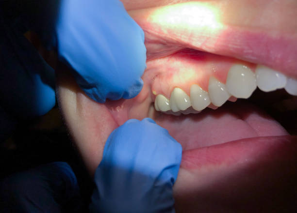 Best Emergency Treatment for Dental Infections or Abscesses in Shelter Island Heights, NY